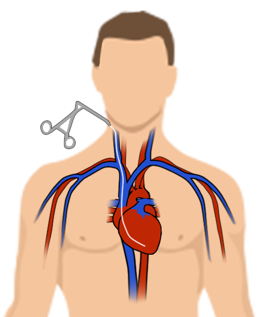 biopsieendomyocardique