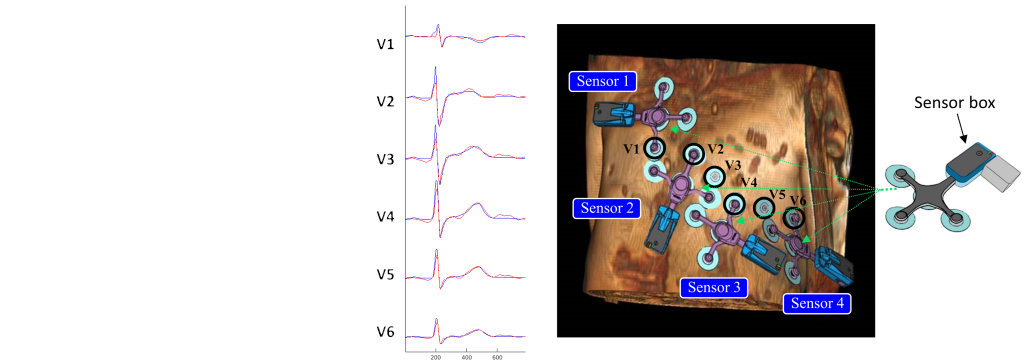 Un système électrocargiographique (ECG) à 12 dérivations, compatible IRM